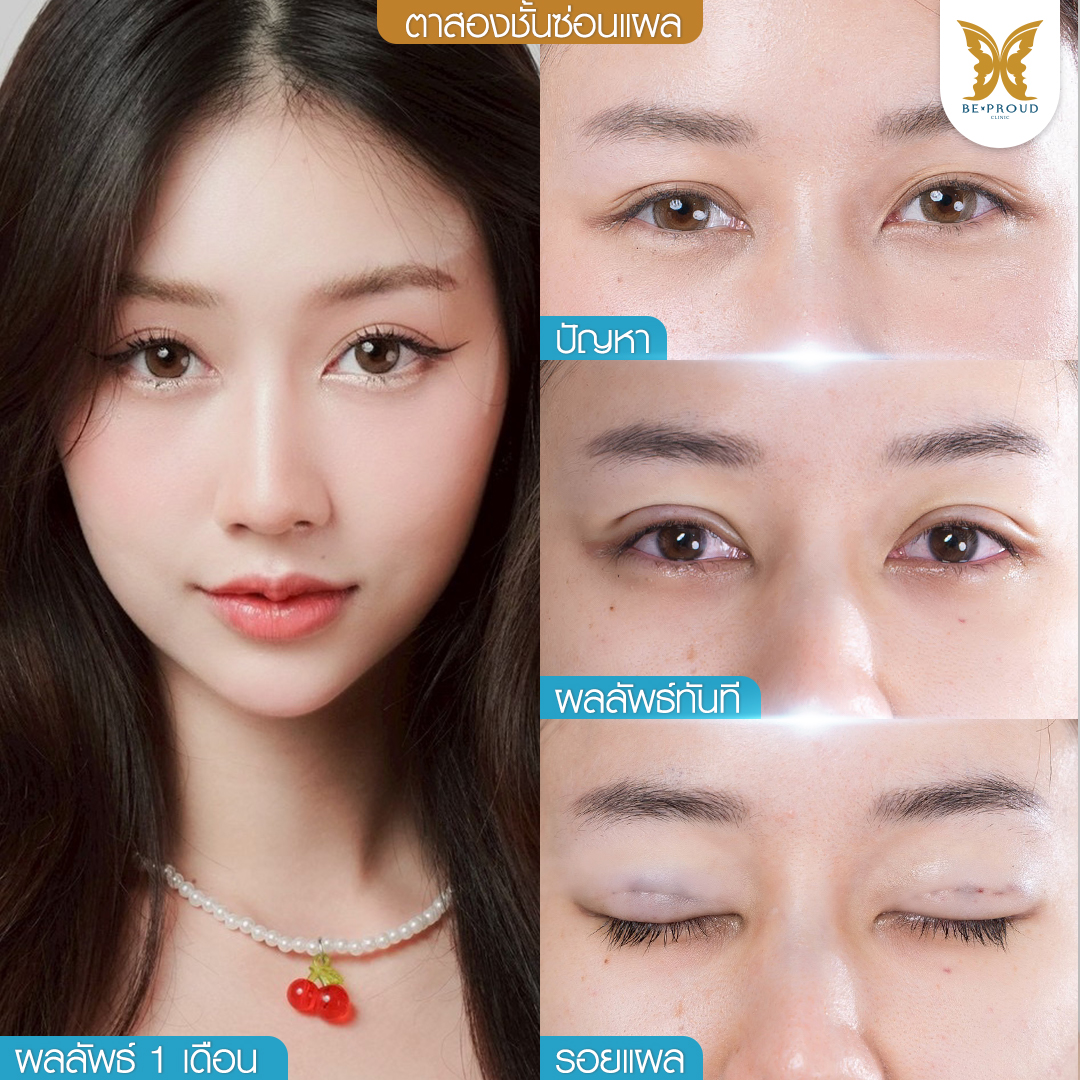 ตาสองชั้น, ทำตาสองชั้น , ปัญหาชั้นตา , ความสวยงาม