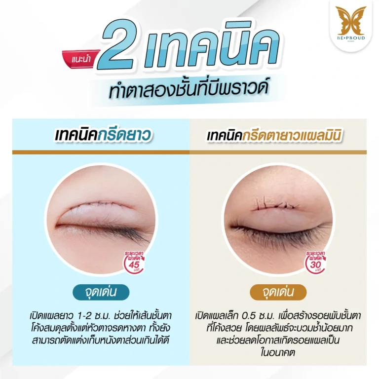 เทคนิคเปิดหัวตา คืออะไร? ช่วยให้ดวงตาดูกลมโตหวานละมุนขึ้นได้อย่างไร Beproud Clinic
