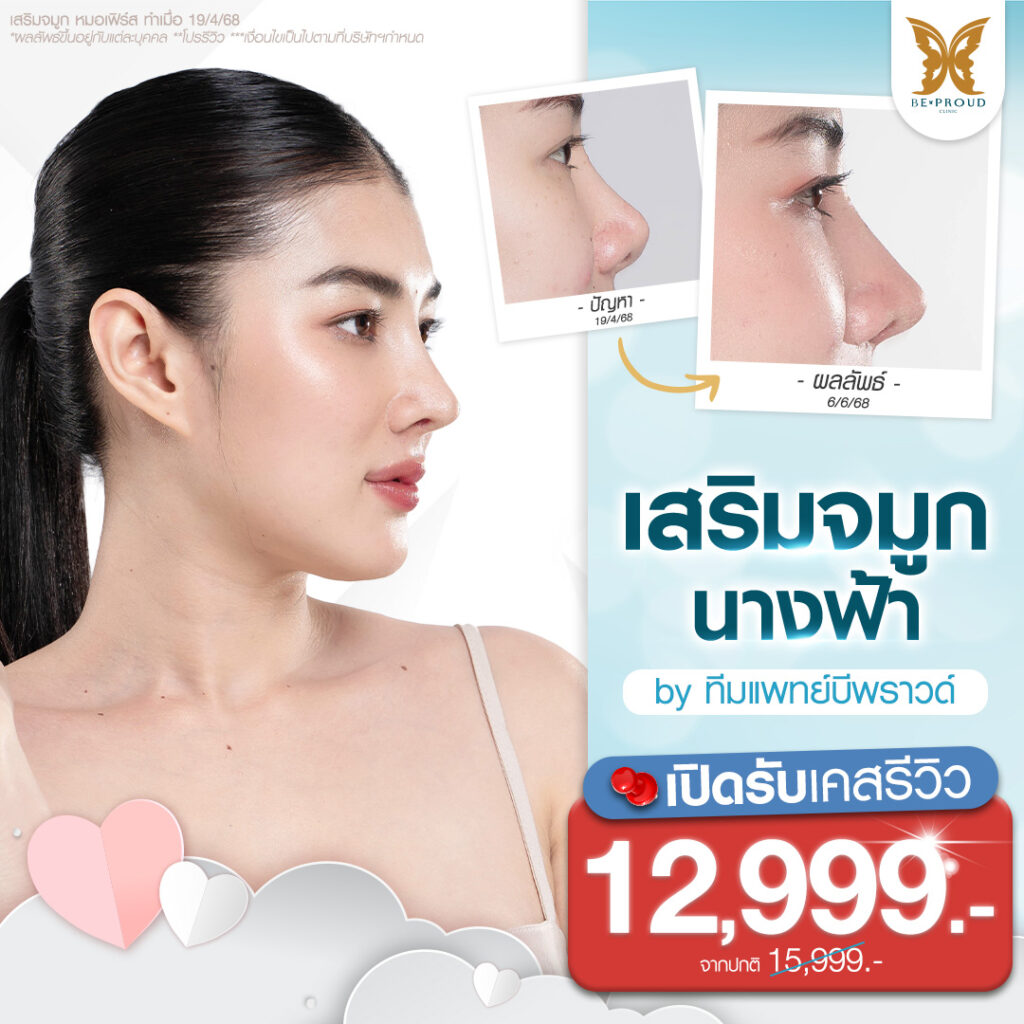 ภาพโปรโมชั่นศัลยกรรมเสริมจมูกนางฟ้าราคาพิเศษสำหรับเคสรีวิว ที่บีพราวด์คลินิก แสดงภาพตัวอย่างเคสลูกค้าเสริมจมูก รีวิวเปรียบเทียบก่อน-หลังทำศัลยกรรมจมูก