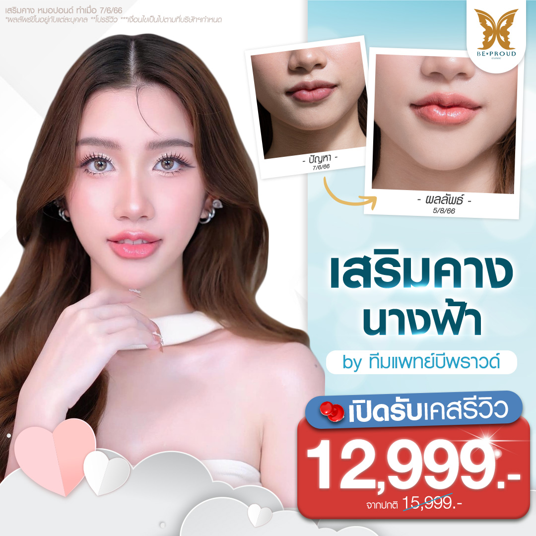 ภาพโปรโมชั่นศัลยกรรมเสริมคางนางฟ้าราคาพิเศษสำหรับเคสรีวิว ที่บีพราวด์คลินิก แสดงภาพตัวอย่างเคสลูกค้าเสริมคาง รีวิวเปรียบเทียบก่อน-หลังทำศัลยกรรมคาง