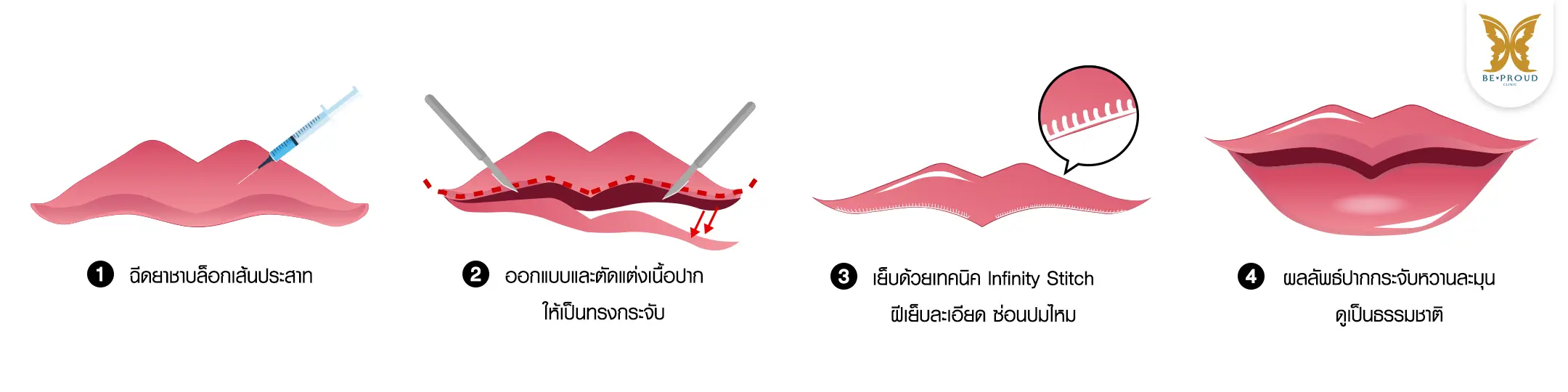 แผนภาพ 4 ขั้นตอนการทำปากกระจับที่ Beproud Clinic ฉีดยาชา, ออกแบบตัดแต่งเนื้อปาก, เย็บด้วยเทคนิค Infinity Stitch, ผลลัพธ์ทรงกระจับธรรมชาติ
