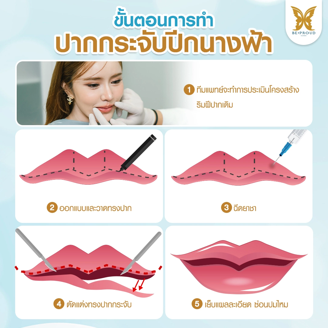 แผนภาพแสดง 5 ขั้นตอนการทำปากกระจับปีกนางฟ้า ที่ BEPROUD Clinic ได้แก่ ประเมินโครงสร้าง ออกแบบฉีดยาชา ตัดแต่ง และเย็บแผลละเอียด