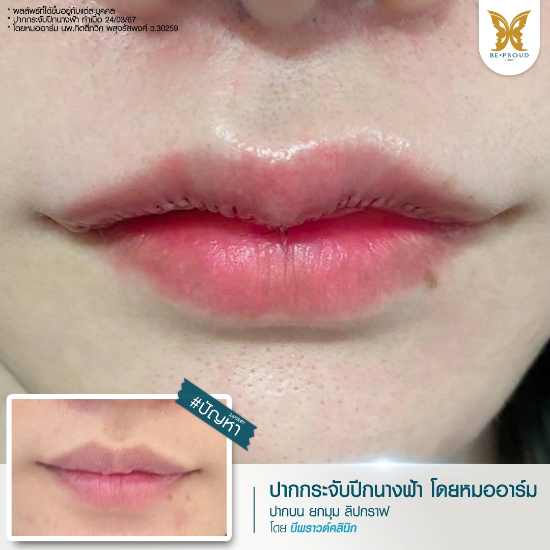 ภาพผลลัพธ์ ศัลยกรรมปากกระจับปีกนางฟ้า หลังทำโดยหมออาร์ม ริมฝีปากที่ถูกปรับให้ดูเป็นทรงสวยงาม