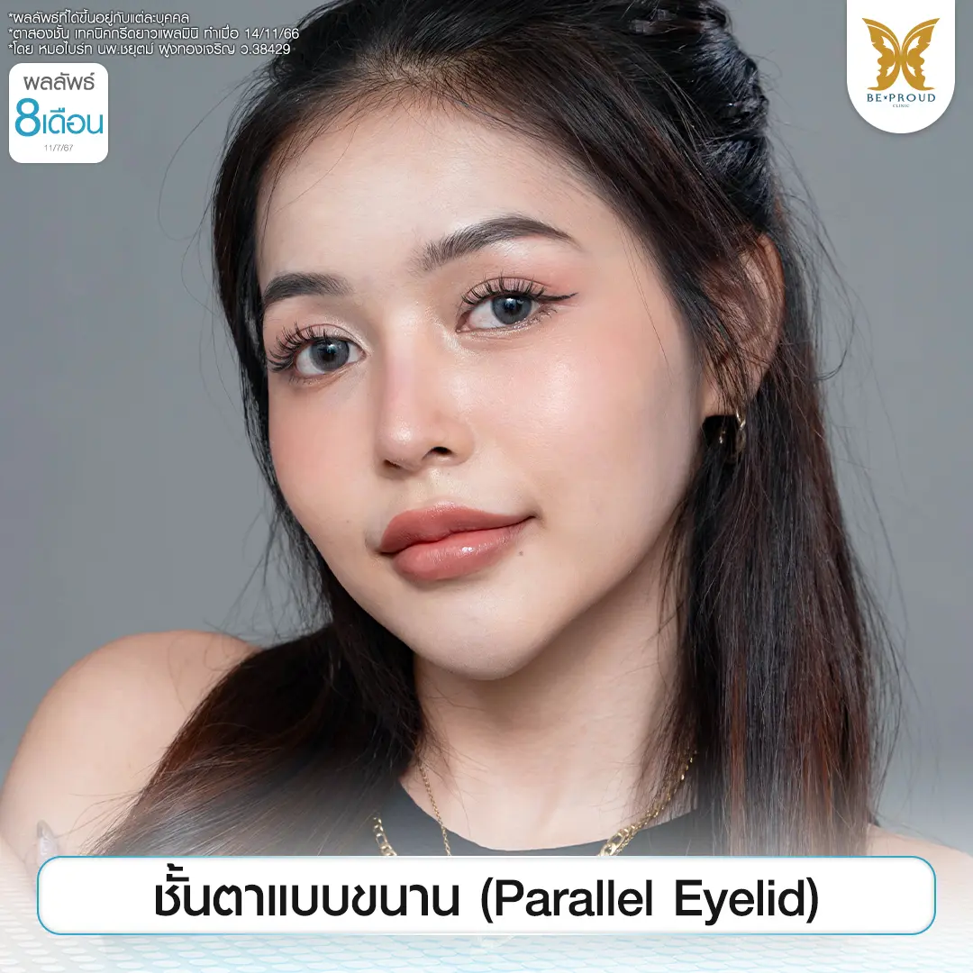 รีวิวตาสองชั้นแบบขนาน (Parallel Eyelid) ผลลัพธ์ 8 เดือน โดยหมอไบร์ท บีพราวด์คลินิก ดวงตากลมโต คมชัด เส้นชั้นตาขนานตั้งแต่หัวตาจรดหางตา เหมาะกับสายฝอและการแต่งหน้า