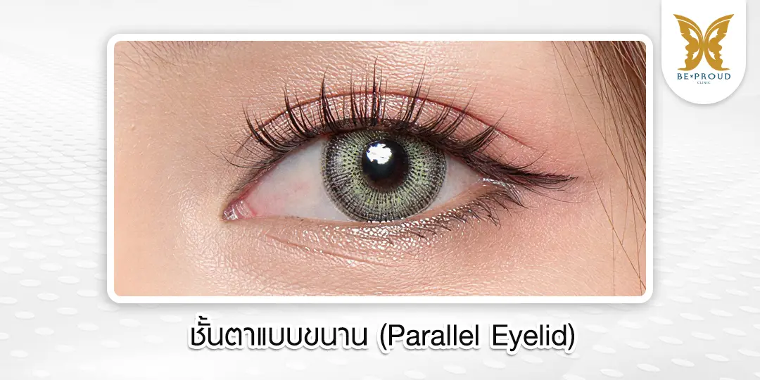 ตัวอย่างลักษณะชั้นตาแบบขนาน (Parallel Eyelid) สไตล์เกาหลี มีความกว้างสม่ำเสมอตั้งแต่หัวตาจรดหางตา ให้ลุคโฉบเฉี่ยว ตาโตคมชัด เหมาะกับการแต่งหน้า จากบีพราวด์คลินิก