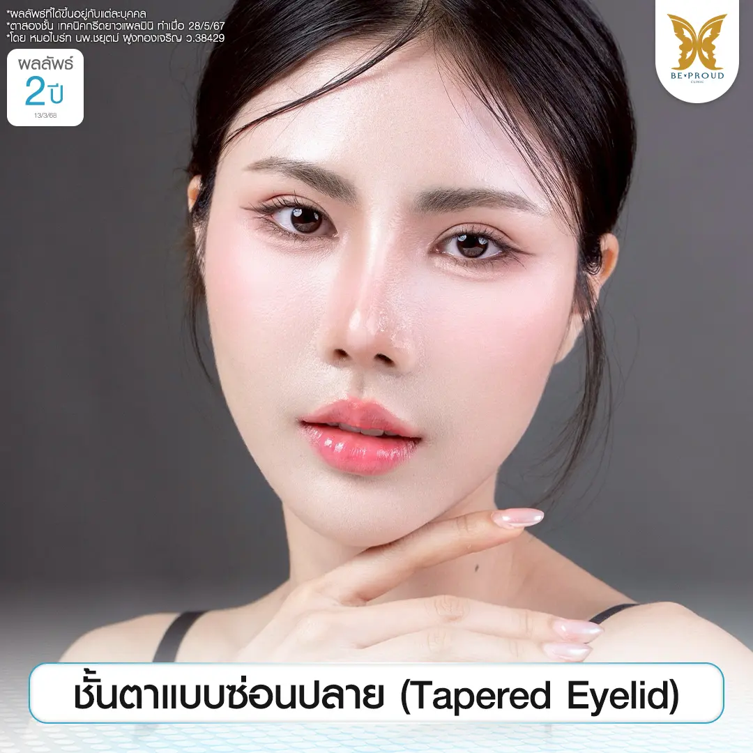 รีวิวตาสองชั้นแบบซ่อนปลาย (Tapered Eyelid) สไตล์เกาหลี ผลลัพธ์ครบ 2 ปี โดยหมอไบร์ท บีพราวด์คลินิก ลักษณะหัวตาปิดและชั้นตาค่อยๆ กว้างขึ้นช่วงหางตา ดูสวยหวานเป็นธรรมชาติ