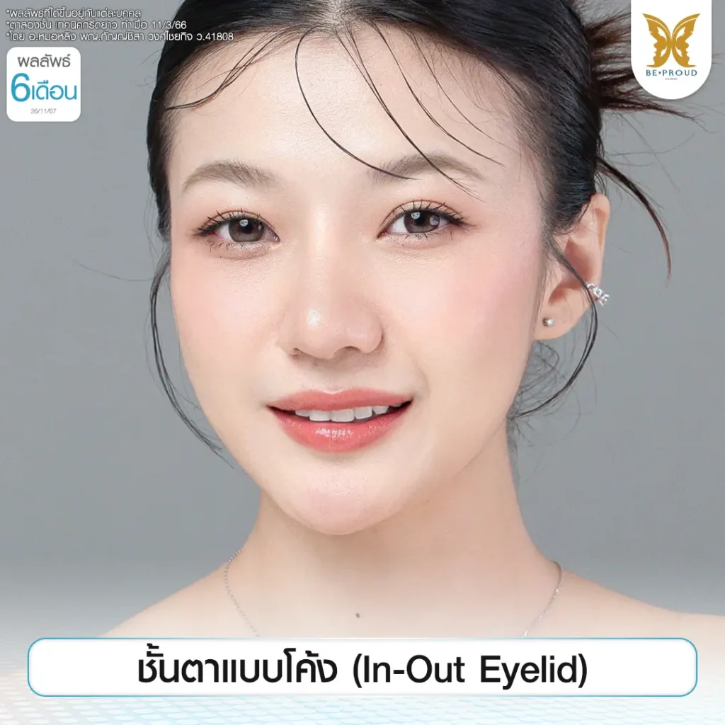 ตาสองชั้น ดาราเกาหลี ตาสองชั้น ดาราเกาหลี: เทรนด์ตาสวยหวานเป็นธรรมชาติ ทำที่ไหนดี?