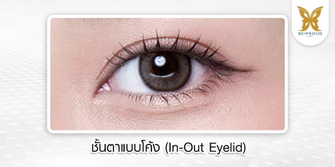ภาพตัวอย่างลักษณะชั้นตาแบบโค้ง (In-Out Eyelid) สไตล์เกาหลี ที่ผสมผสานระหว่างแบบซ่อนปลายและแบบขนาน เริ่มต้นหัวตาแคบแล้วขยายออกขนานกับขอบตา ให้ลุคตากลมโตและหวานละมุน จากบีพราวด์คลินิก