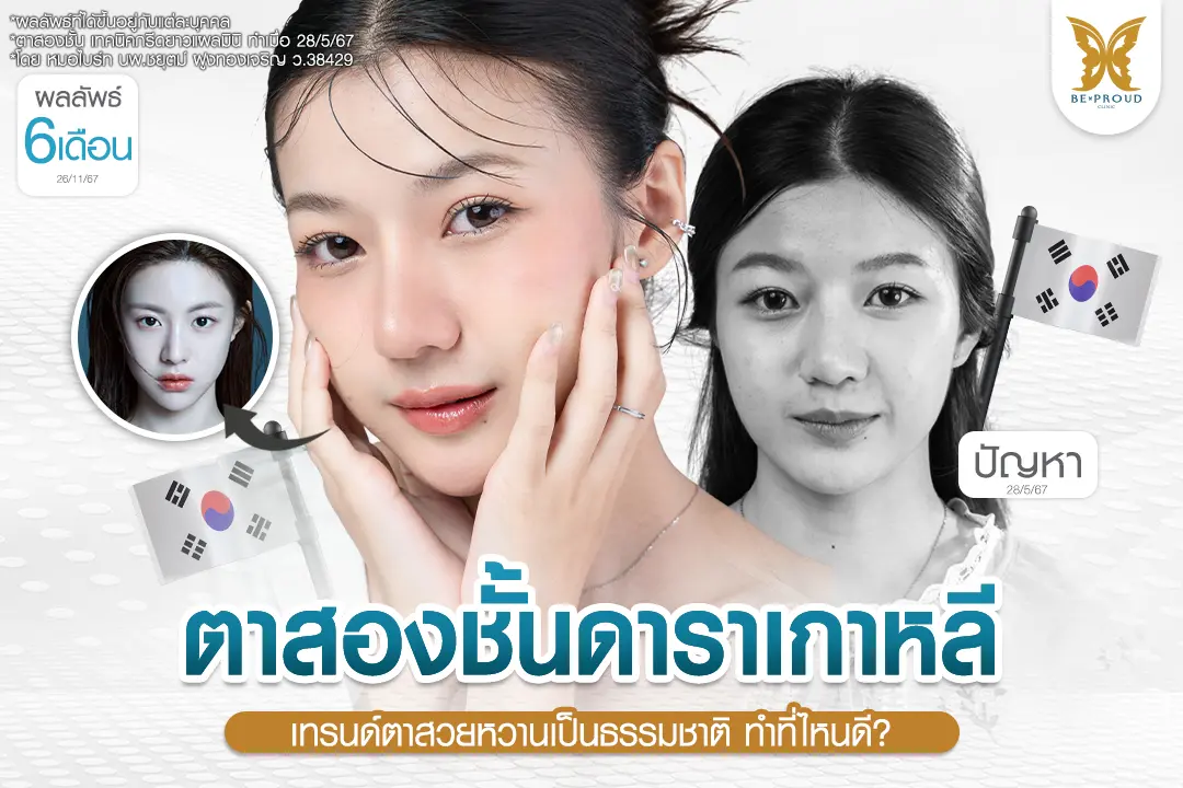 ตาสองชั้นดาราเกาหลี เปรียบเทียบก่อนและหลังทำ 6 เดือน เทคนิคกรีดยาวแผลมินิ บีพราวด์คลินิก เปลี่ยนตาหมวยเป็นตาสวยหวานธรรมชาติ