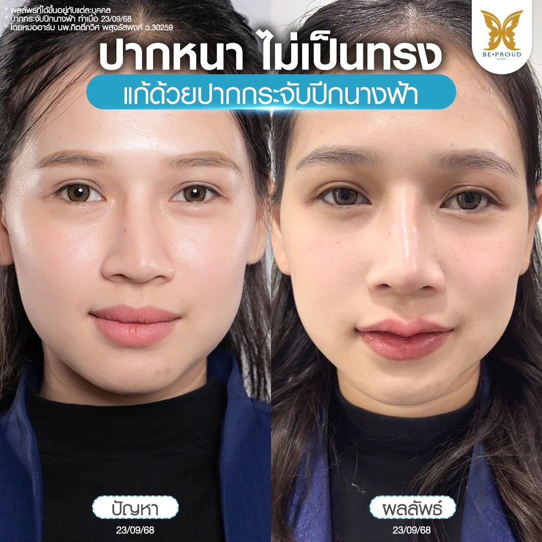 ภาพรีวิว ก่อน-หลังศัลยกรรมปากกระจับปีกนางฟ้า โดยหมออาร์ม แก้ปัญหาปากหนา ไม่เป็นทรงให้ได้รูปปากที่ โค้งสวยเป็นธรรมชาติ