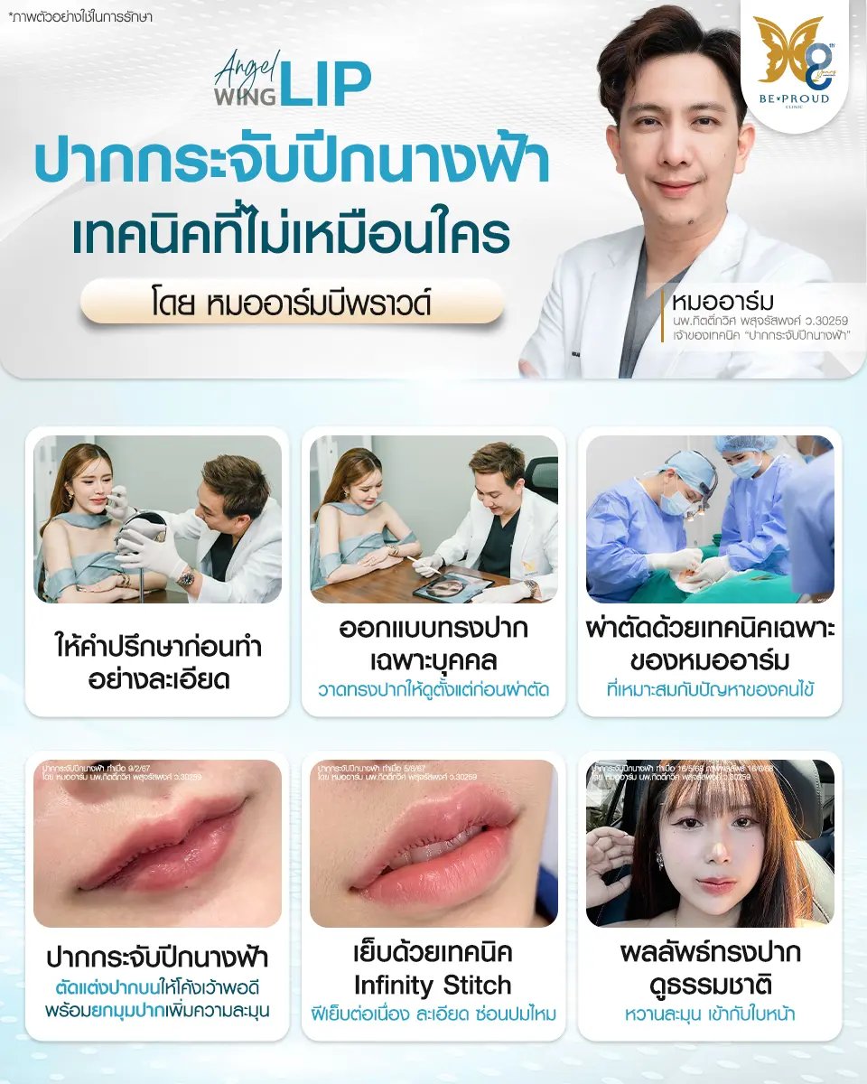 ปากกระจับปีกนางฟ้า เทคนิคเฉพาะโดยหมออาร์ม BEPROUD Clinic การออกแบบเฉพาะบุคคล เย็บด้วยเทคนิค Infinity Stitch ให้ผลลัพธ์ทรงปากธรรมชาติ