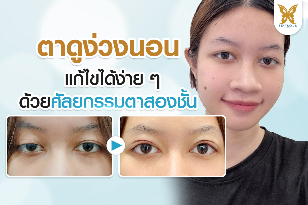 รีวิวศัลยกรรมตาสองชั้น แก้ปัญหาตาดูง่วงนอน เปรียบเทียบภาพก่อนและหลัง