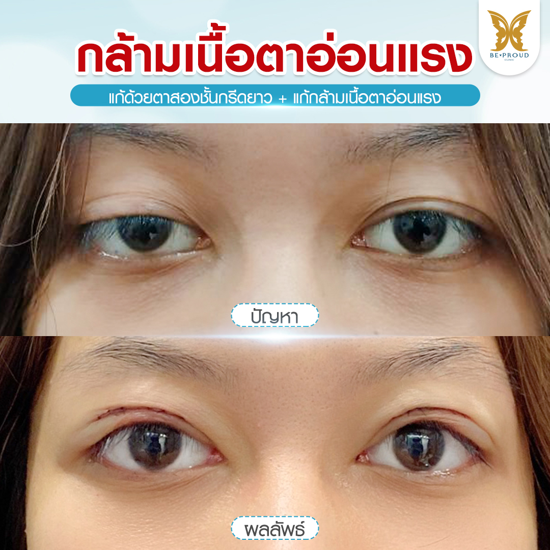 รีวิวศัลยกรรมตาสองชั้น Mini ANGEL EYELID แก้กล้ามเนื้อตาอ่อนแรง ตาดูง่วงนอน เปรียบเทียบภาพก่อนและหลังทำ