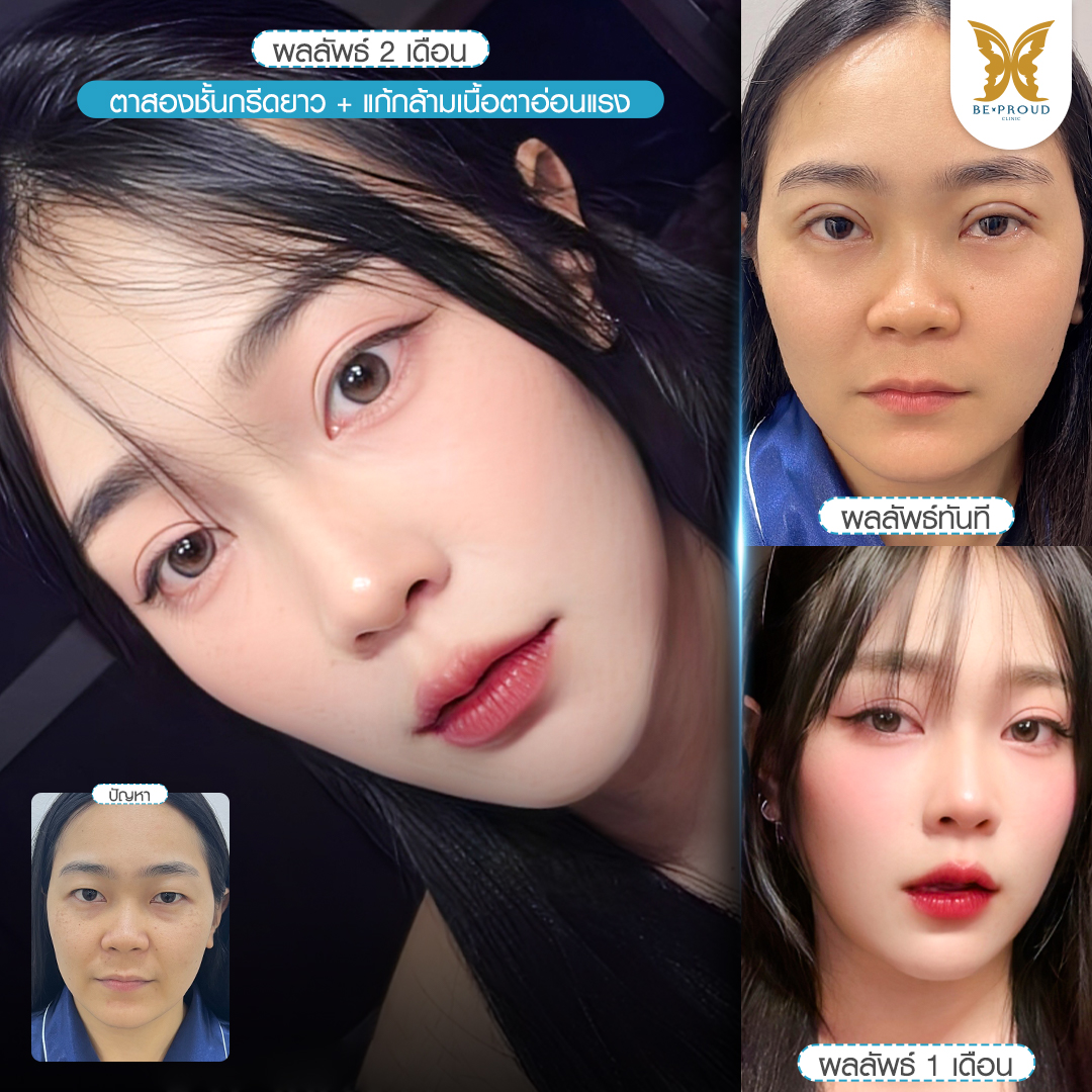 รีวิวศัลยกรรมตาสองชั้นกรีดยาว แก้กล้ามเนื้อตาอ่อนแรง ตาดูง่วง เปรียบเทียบผลลัพธ์หลังทำตาสองชั้น ที่บีพราวด์คลินิก