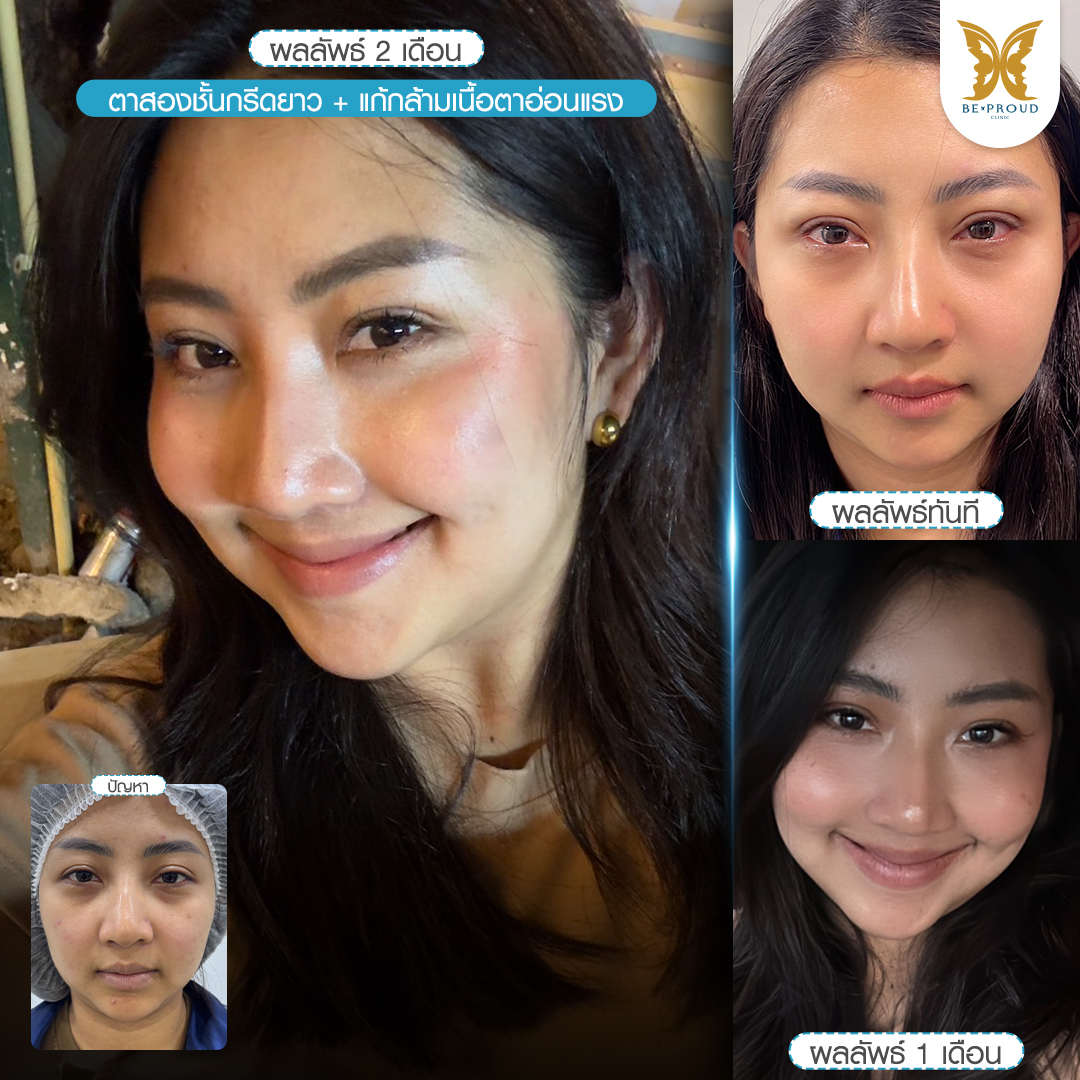 รีวิวศัลยกรรมตาสองชั้นกรีดยาว แก้กล้ามเนื้อตาอ่อนแรง ตาดูง่วง เปรียบเทียบผลลัพธ์หลังทำตาอสองชั้น ที่บีพราวด์คลินิก