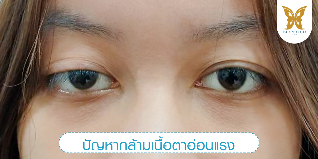 ภาพแสดงปัญหากล้ามเนื้อตาอ่อนแรง ตาดูง่วงนอน ของลูกค้าก่อนการทำศัลยกรรมตาสองชั้น ที่บีพราวด์คลินิก