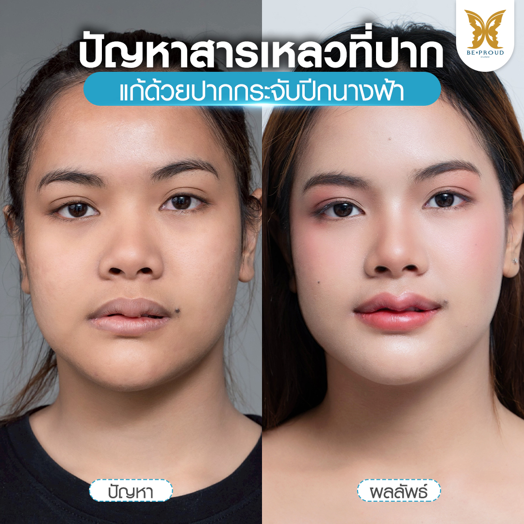 รูปเปรียบเทียบก่อนและหลังผ่าตัดศัลยกรรมปากกระจับปีกนางฟ้า แก้ปัญหาสารเหลวที่ปาก ที่บีพราวด์คลินิก