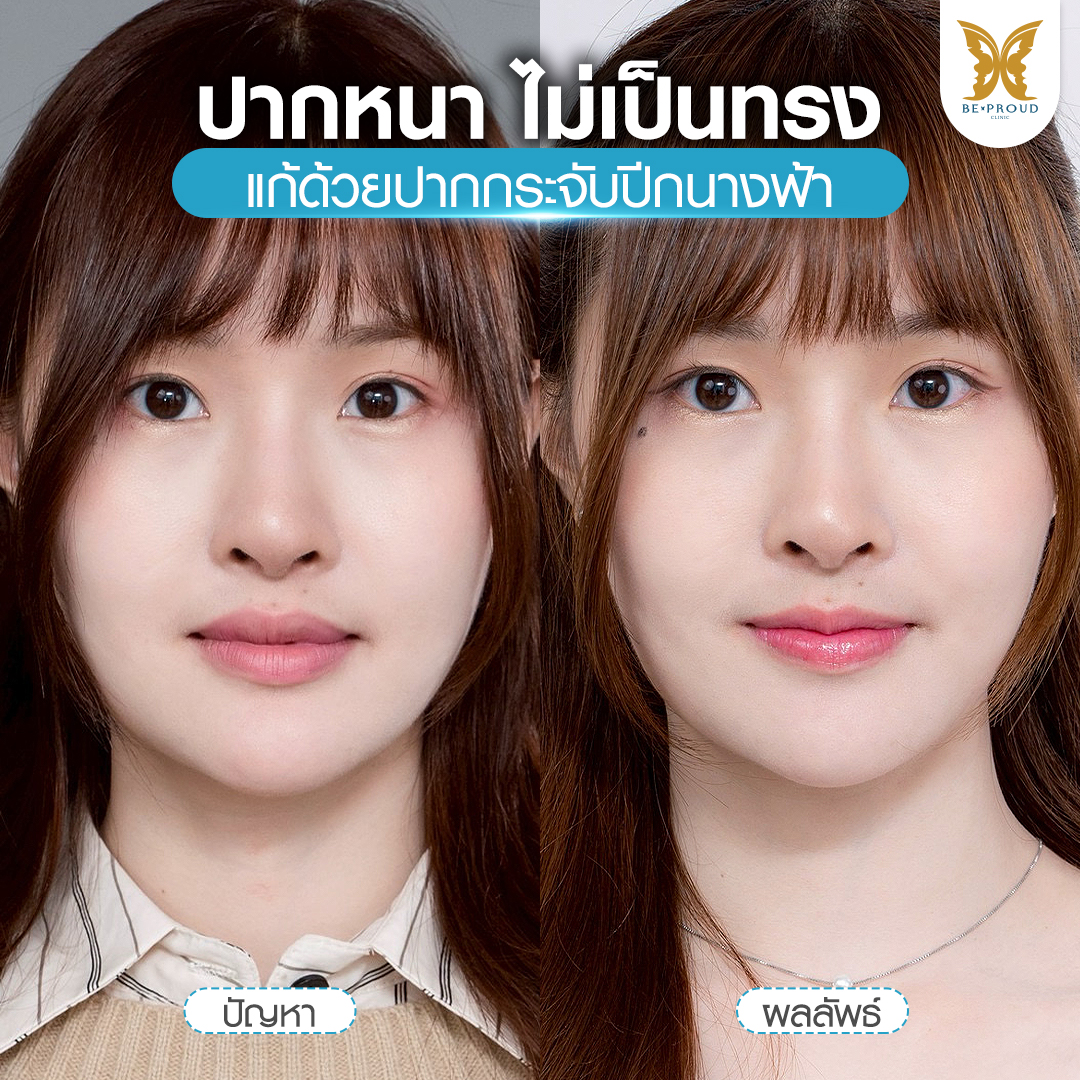 ทำความรู้จัก "ปากกระจับ" เทรนด์ความงามที่มาแรงที่สุดในยุคนี้! ปากกระจับ, ทำปากกระจับ, ศัลยกรรมปากกระจับ, ปากกระจับที่ไหนดี