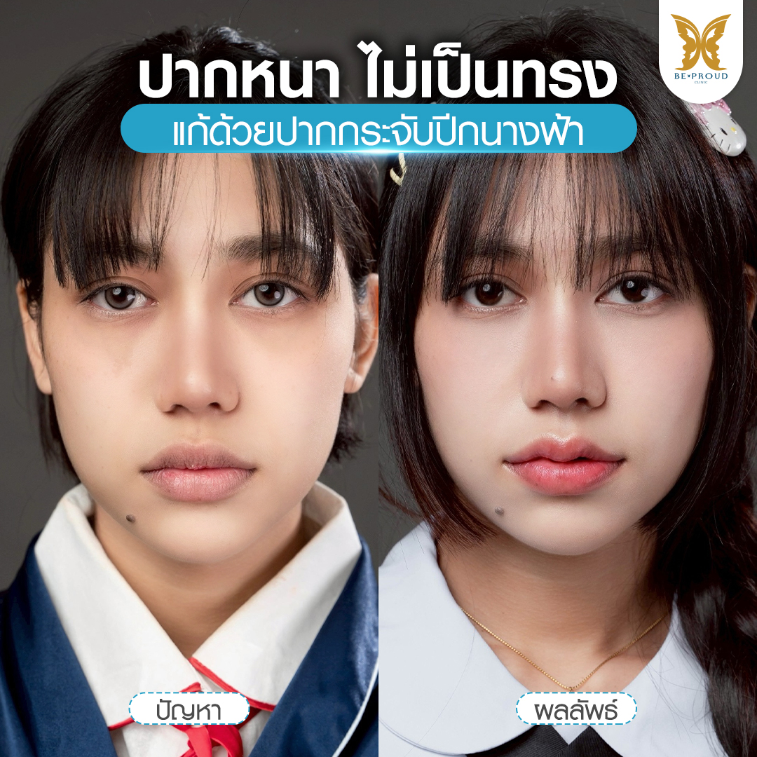 รูปเปรียบเทียบก่อนและหลังผ่าตัดศัลยกรรมปากกระจับปีกนางฟ้า แก้ปากหนา ปากไม่เป็นทรง ที่บีพราวด์คลินิก