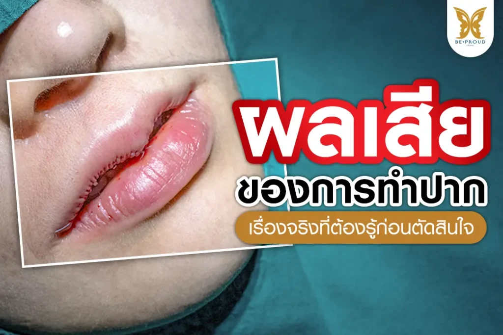 ผลเสียของการทำปากกระจับ เรื่องจริงที่ต้องรู้ก่อนตัดสินใจ เช่น ปากบางเกินไป ปากเบี้ยว และพังผืด