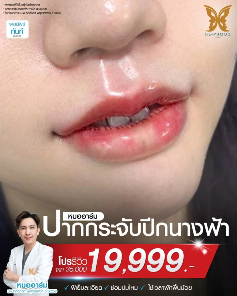 ปากกระจับ ปากกระจับ: ที่สุดของเทรนด์ปากสวยเป็นธรรมชาติที่ BEPROUD Clinic