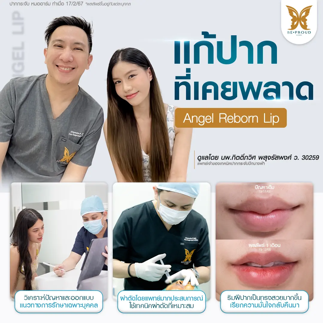 ภาพศัลยกรรมแก้ปากที่เคยพลาด (Angel Reborn Lip) ที่ Beproud Clinic โดยหมออาร์ม วิเคราะห์ออกแบบเฉพาะบุคคล รับประกันผลลัพธ์ปากกระจับทรงสวย