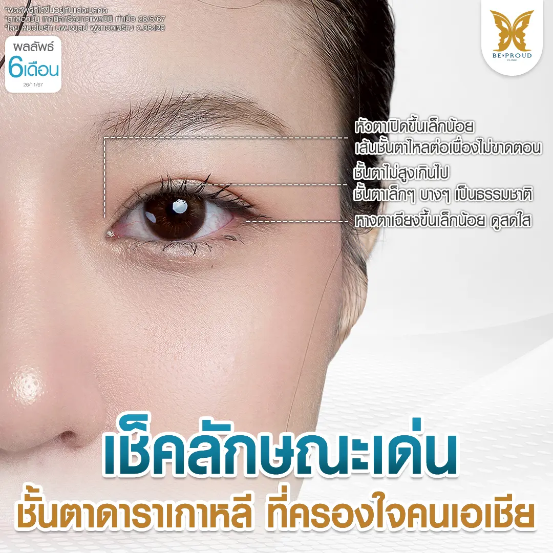 5 ลักษณะเด่นของตาสองชั้นสไตล์ดาราเกาหลี ได้แก่ หัวตาเปิด, เส้นชั้นตาต่อเนื่อง, ชั้นตาไม่สูงเกินไป, ชั้นตาเล็กบางเป็นธรรมชาติ, และหางตาเฉียงขึ้นเล็กน้อย รีวิวผลลัพธ์ 6 เดือนที่ บีพราวด์คลินิก