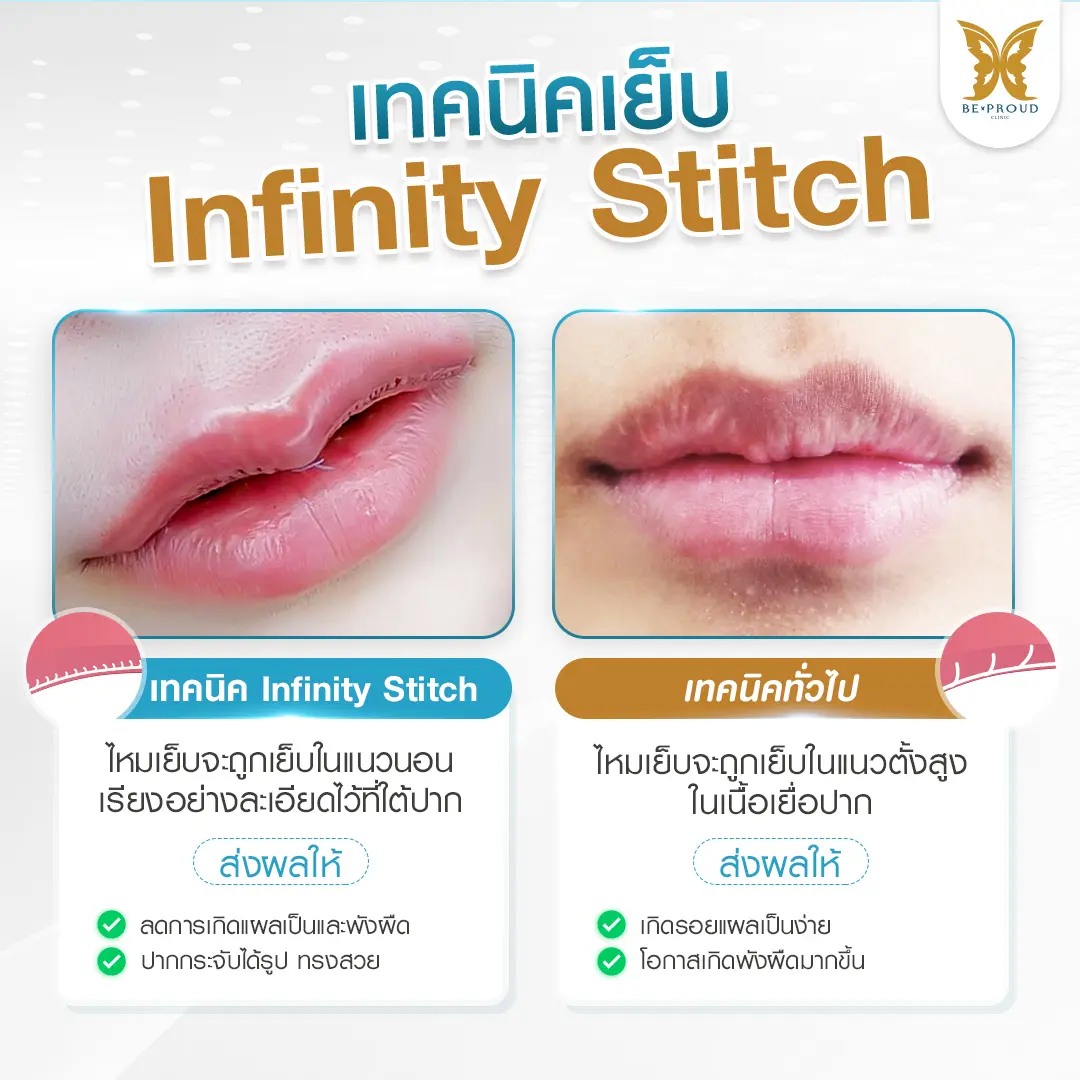 ภาพเปรียบเทียบเทคนิคเย็บปากกระจับ Infinity Stitch ของบีพราวด์คลินิก ที่เย็บแนวนอนซ่อนปมไหม ลดการเกิดแผลเป็นและพังผืด เทียบกับเทคนิคทั่วไปที่เย็บแนวตั้ง ซึ่งเสี่ยงเกิดรอยแผลเป็นง่ายกว่า