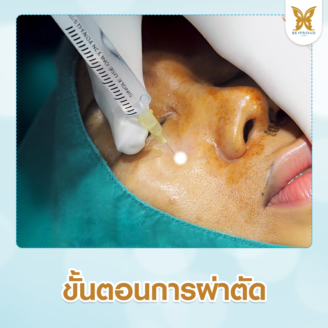 ขั้นตอนการผ่าตัดปากกระจับโดยแพทย์เฉพาะทาง ฉีดยาชาและตกแต่งทรงปากอย่างประณีต