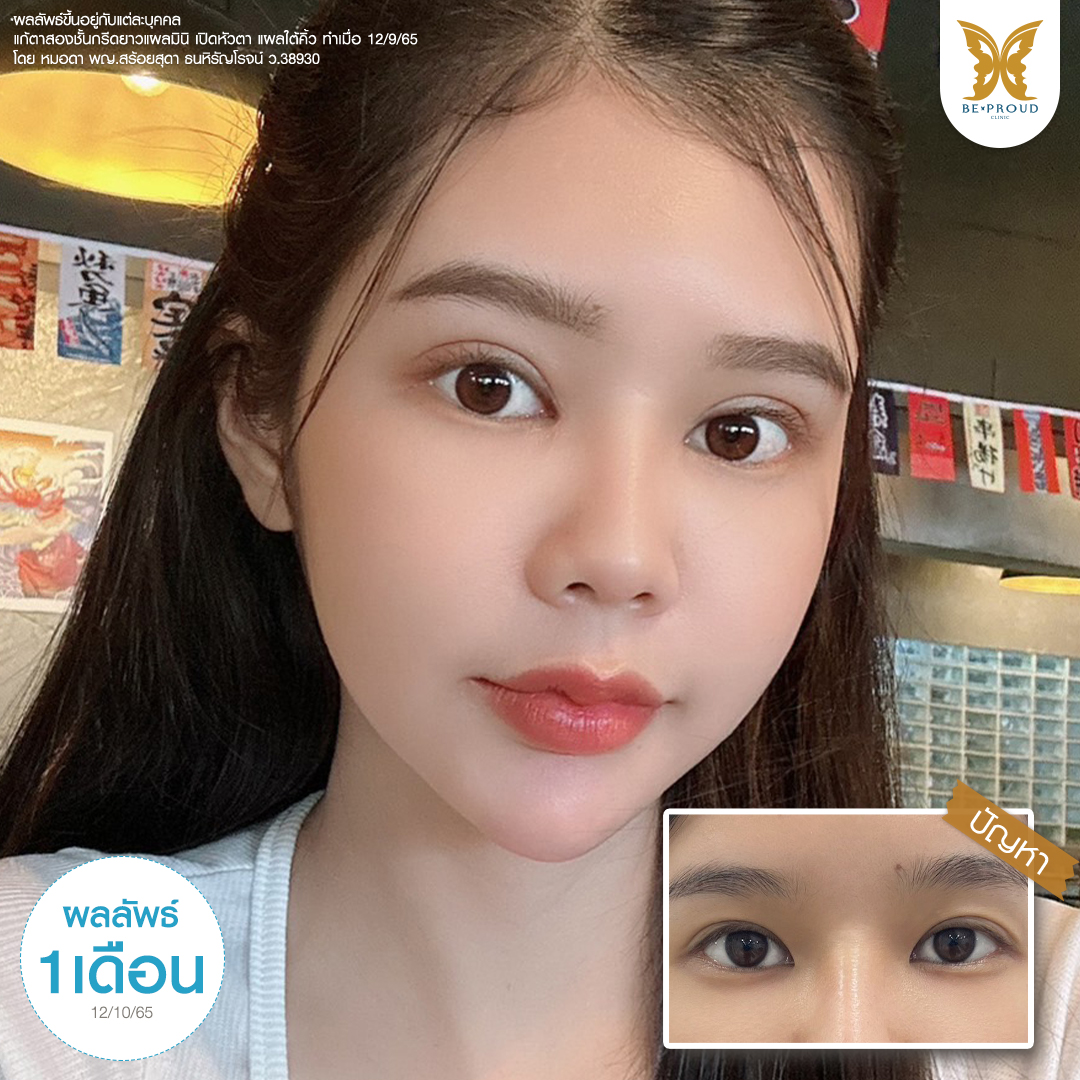 ผลลัพธ์หลังทำตาสองชั้นและเปิดหัวตา 1 เดือน