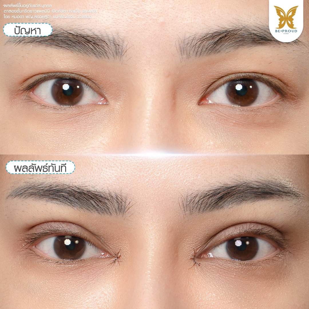 ภาพก่อนและหลังทำเปิดหัวตา ผลลัพธ์ทันทีหลังผ่าตัด