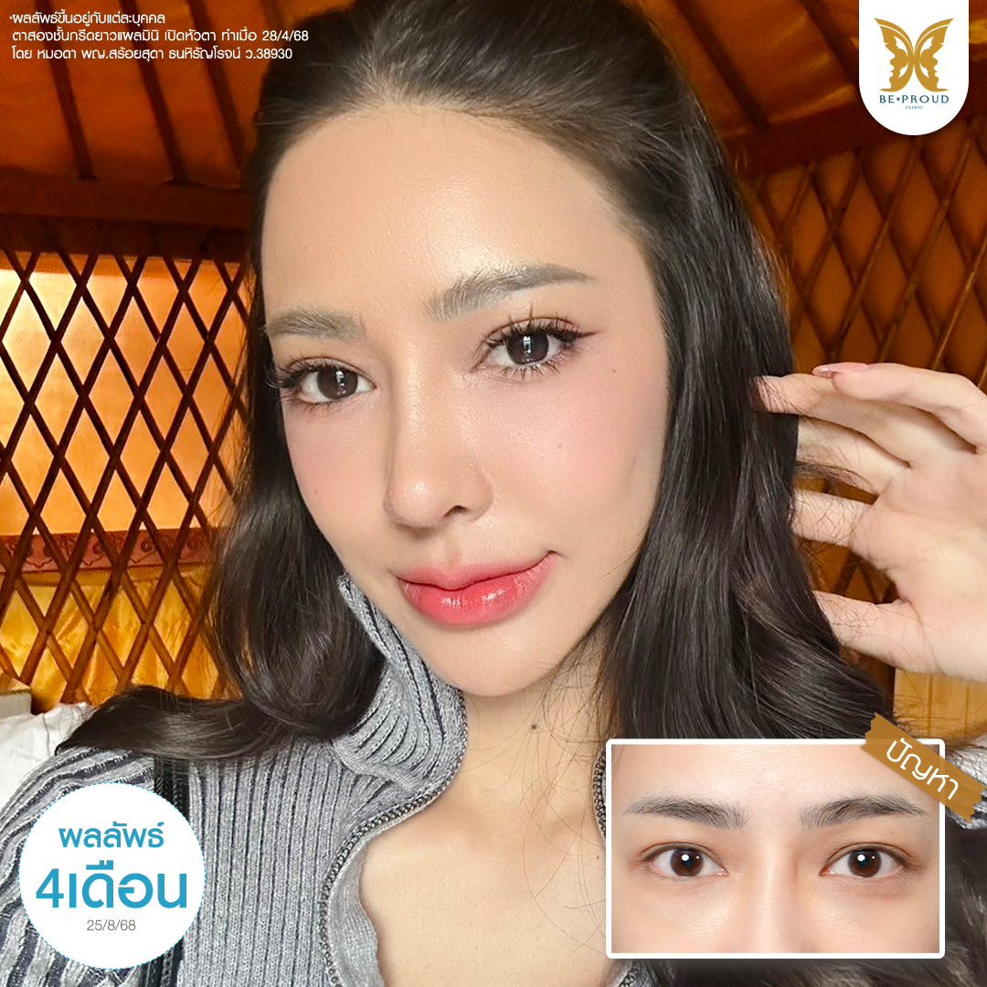 รีวิวเปิดหัวตา 4 เดือนหลังทำ ดวงตากลมโตดูเป็นธรรมชาติ