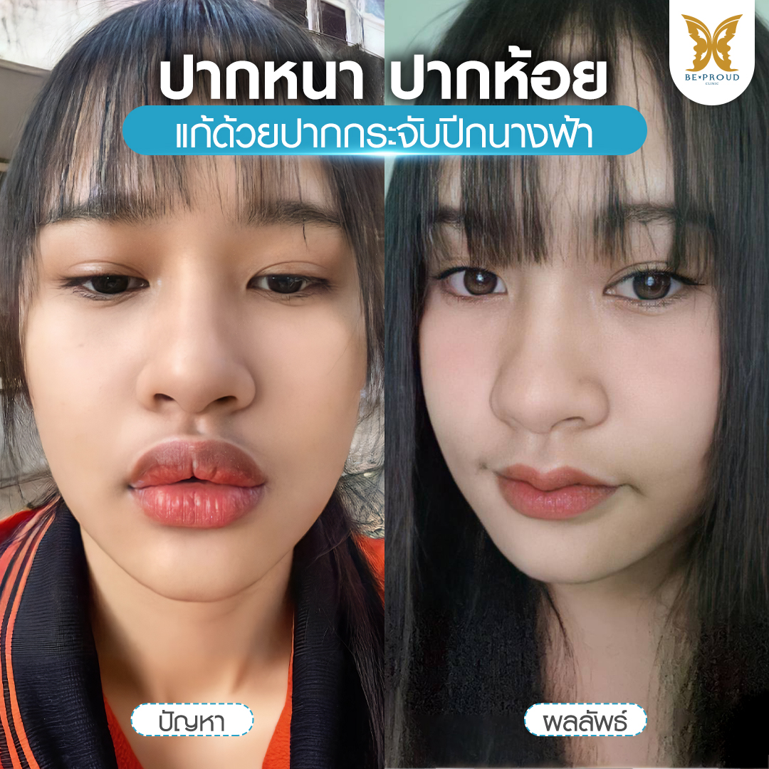 ก่อนหลังทำศัลยกรรมปากกระจับ แก้ปัญหาปากหนา ปากห้อย ให้ปากบางสวย ดูละมุนขึ้น