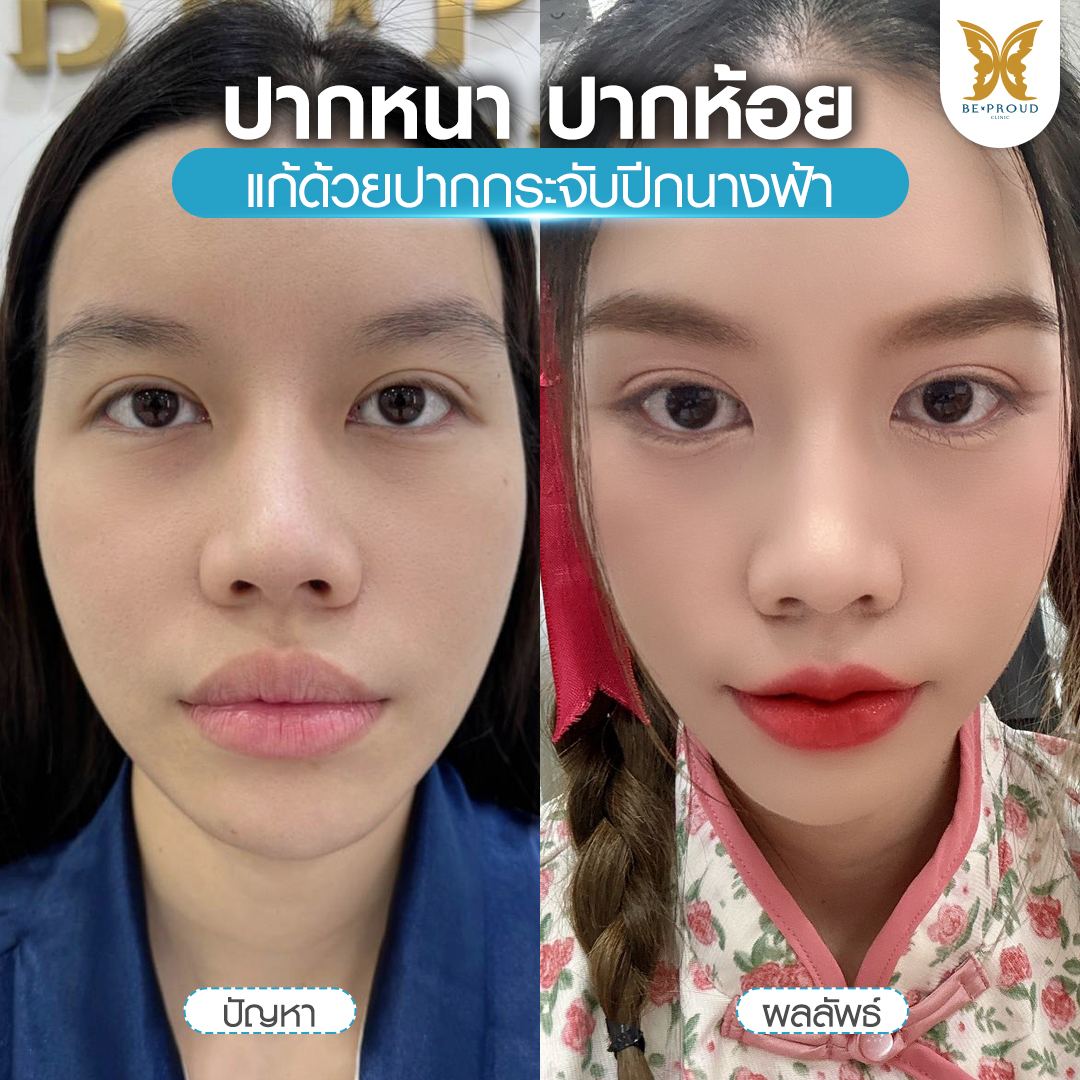 เปรียบเทียบผลลัพธ์ศัลยกรรมปากกระจับ แก้ปัญหาปากหนา ปากห้อย ให้ได้รูปปากที่บางสวย ยกมุมปากละมุน