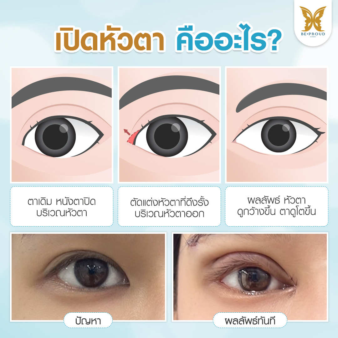 ภาพอธิบายขั้นตอนการผ่าตัดเปิดหัวตา ช่วยแก้หนังตาปิดบริเวณหัวตาให้ดวงตาดูกลมโตขึ้น