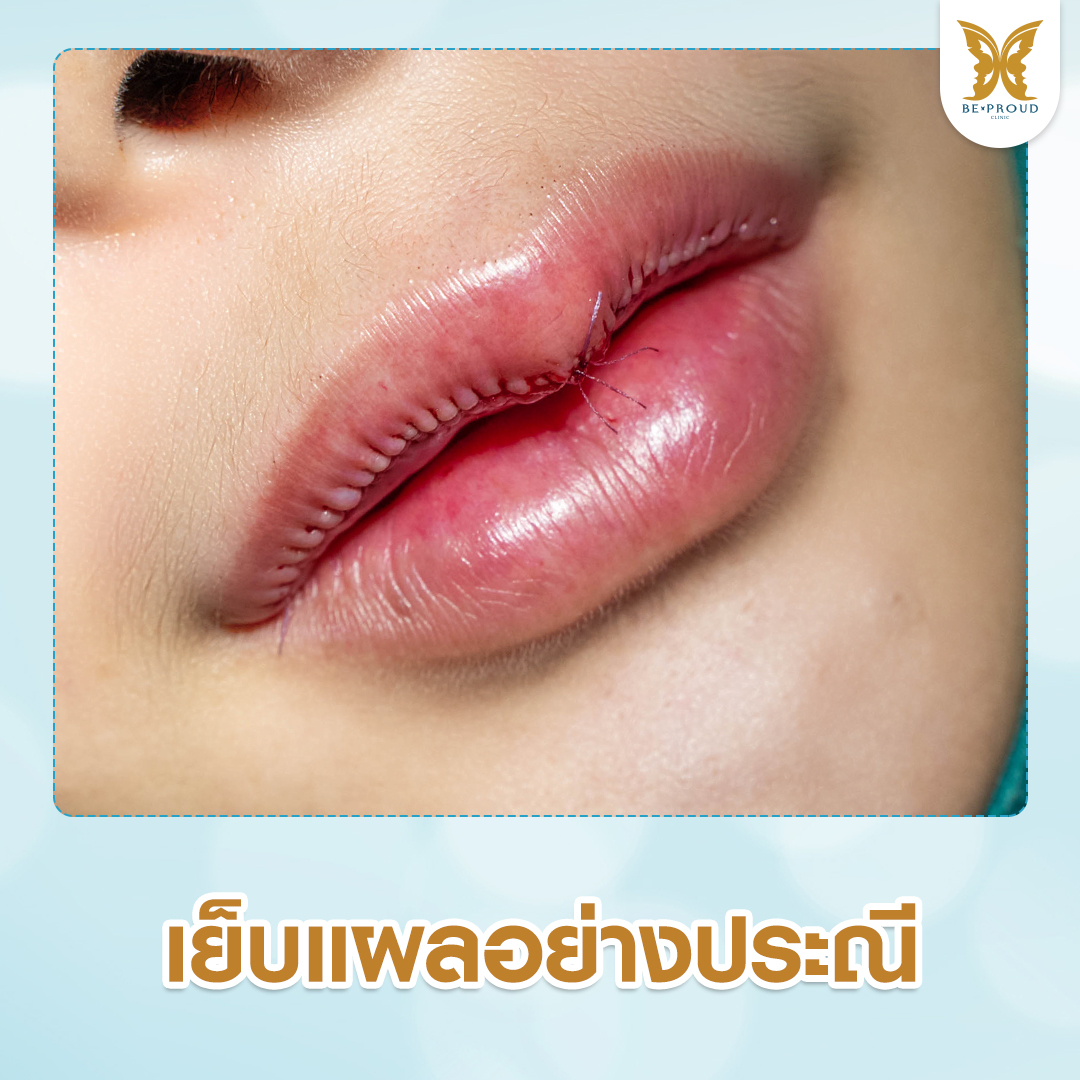 แผลเย็บหลังทำศัลยกรรมปาก เย็บแผลเรียบสวยอย่างประณีตโดยแพทย์ผู้เชี่ยวชาญ