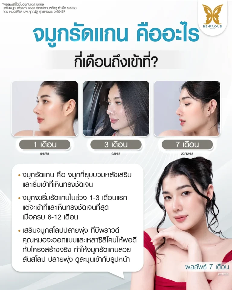 ไขข้อสงสัยคนทำจมูก จมูกรัดแกนใช้เวลากี่เดือน? ไทม์ไลน์ความสวยแต่ละช่วงเวลา 1 เดือน, 3 เดือน และ 7 เดือน ที่ค่อยๆ ยุบบวมและผิวหนังแนบเข้ากับซิลิโคน จนเห็นทรงสโลปปลายพุ่งชัดเจนขึ้นอย่างเป็นธรรมชาติ