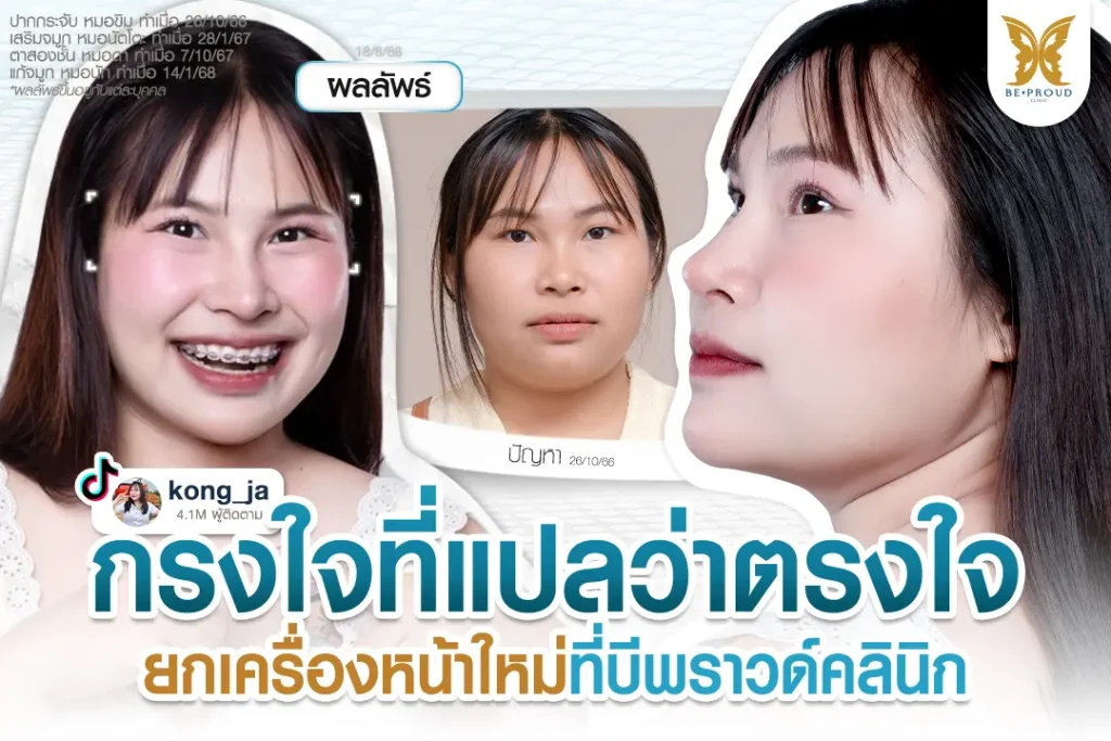 ภาพ Before-After ศัลยกรรมครบวงจรของ คุณกรงใจ ปากกระจับหมอขิม เสริมจมูกหมอนัตโตะ แก้จมูกหมอนัทและตาสองชั้นหมอดา
