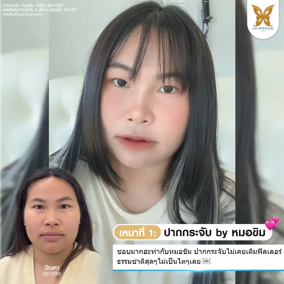 ภาพรีวิว ตาสองชั้นแผลมินิของคุณกรงใจ หลังทำโดย หมอดา แก้ไขปัญหาตาหมวย ตาดุ ให้ดูหวานละมุนขึ้น