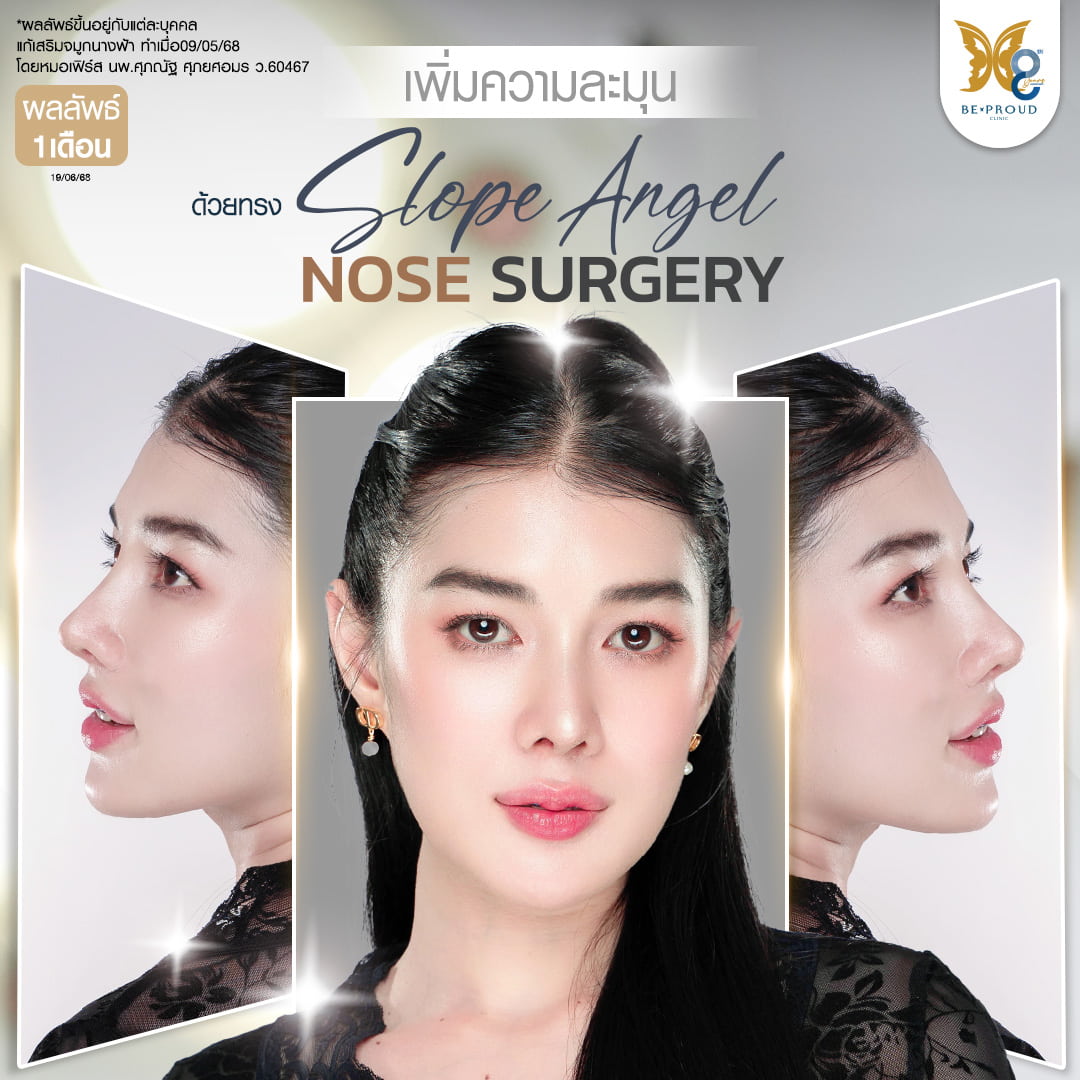 ภาพรีวิวผลลัพธ์การแก้เสริมจมูกทรง Slope Angel Nose Surgery ครบ 1 เดือน โดยหมอเฟิร์ส บีพราวด์ คลินิก มีความละมุน สโลปปลายพุ่งสวยงาม