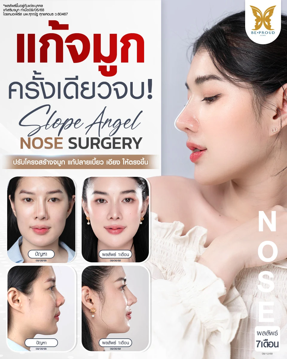 รีวิวแก้จมูกเบี้ยวเอียงโดยหมอเฟิร์ส บีพราวด์ คลินิก เปรียบเทียบไทม์ไลน์ 3 ระยะ คือ ก่อนทำ หลังทำ 1 เดือน และผลลัพธ์ระยะยาว 7 เดือน ทรงจมูก Slope Angel ที่ปรับโครงสร้างให้ตรงและปลายพุ่งสวยงาม