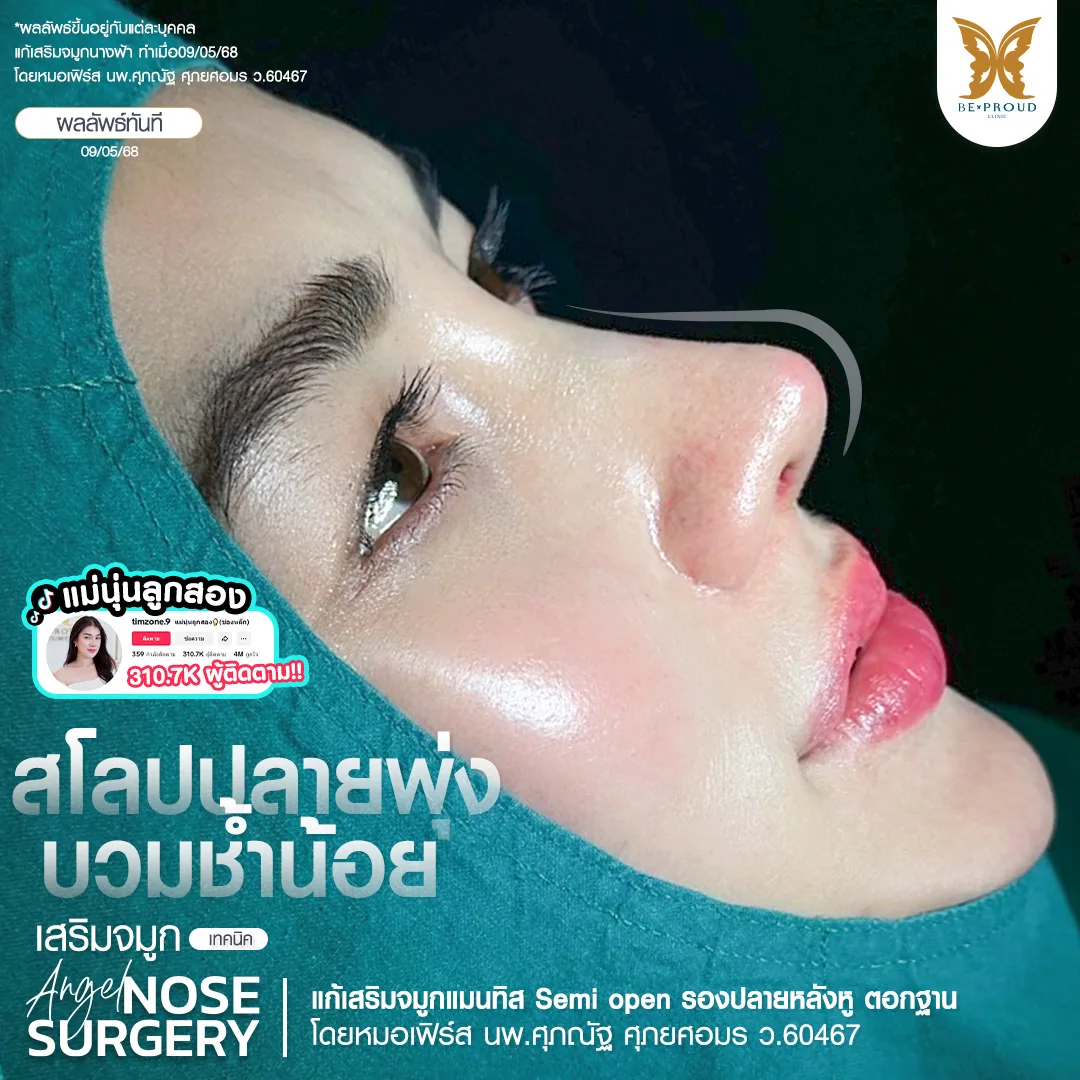 ภาพผลลัพธ์ทันทีหลังแก้จมูกของอินฟลูเอนเซอร์ 'แม่นุ่นลูกสอง' ด้วยเทคนิค Slope Angel Nose Surgery ดูแลโดย หมอเฟิร์ส บีพราวด์ คลินิก ทรงจมูกสโลปปลายพุ่งที่สวยงามและอาการบวมช้ำที่น้อยมาก