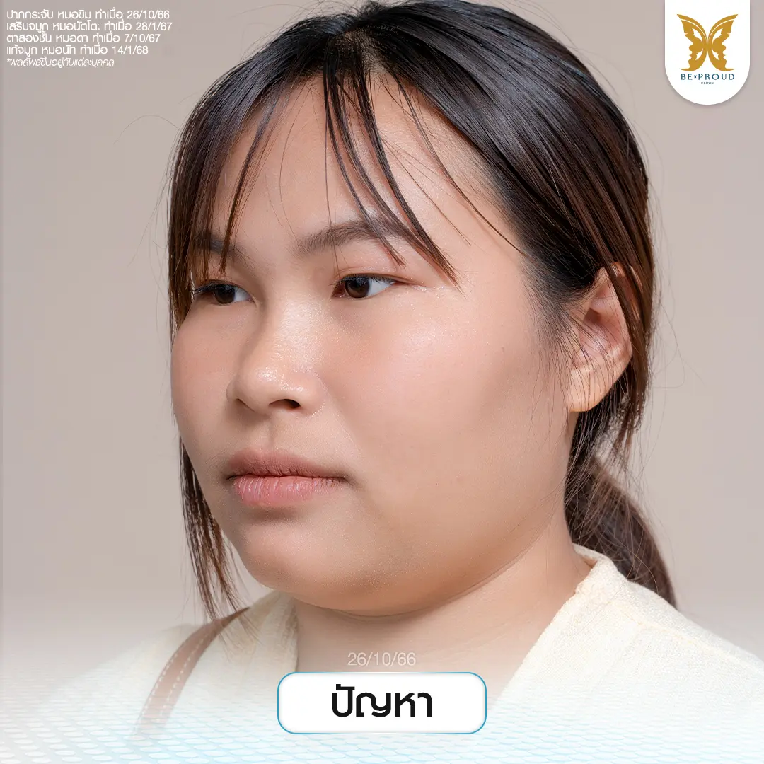 ภาพปัญหาโครงสร้างใบหน้าของคุณกรงใจก่อนศัลยกรรม ก่อนยกเครื่องหน้าใหม่กับทีมแพทย์ Beproud Clinic
