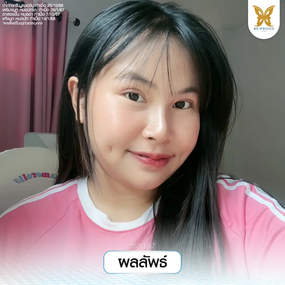 ภาพ ใบหน้าคุณกรงใจหลังศัลยกรรมครบวงจร แสดงผลลัพธ์ ปากกระจับธรรมชาติ จมูกสโลปเป็นทรง และตาสองชั้นที่ทำให้ใบหน้าดูละมุนและหวานขึ้น