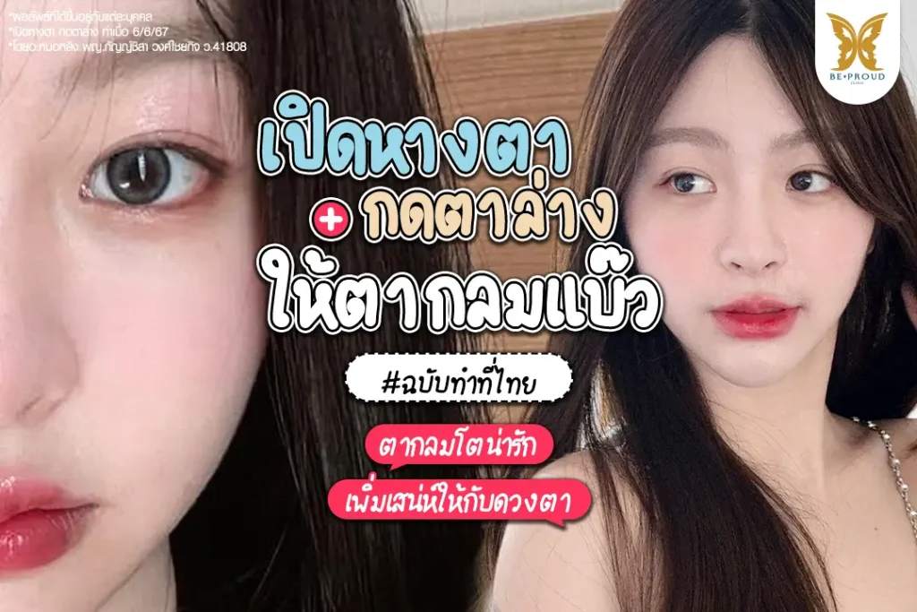 ภาพรีวิวเปิดหางตา และกดตาล่าง ของคุณเบลฉบับทำที่ไทย โดยอ.หมอหลิง ทำให้ดวงตาดูโตกลมแบ๊วและหวานขึ้นอย่างเป็นธรรมชาติ