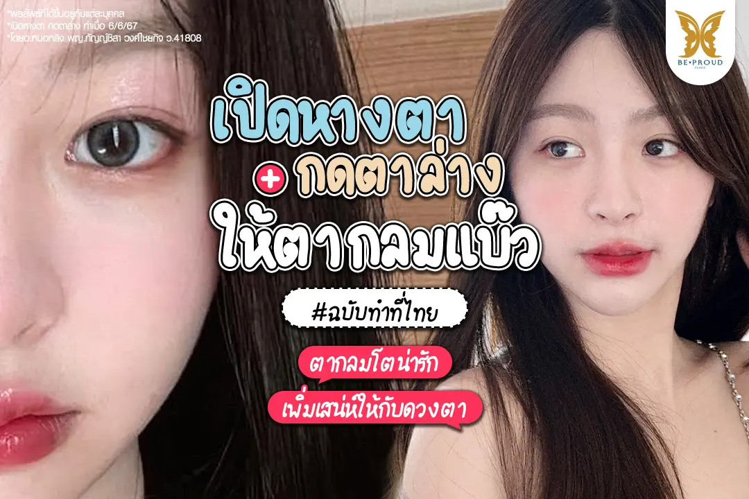 ภาพรีวิวเปิดหางตา และกดตาล่าง ของคุณเบลฉบับทำที่ไทย โดยอ.หมอหลิง ทำให้ดวงตาดูโตกลมแบ๊วและหวานขึ้นอย่างเป็นธรรมชาติ