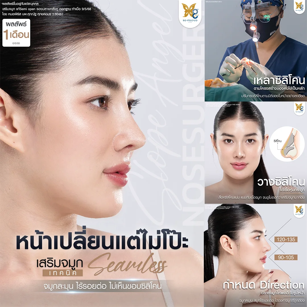 รีวิวผลลัพธ์การเสริมจมูกเทคนิค Seamless เสริมจมูกไร้รอยต่อไม่เห็นขอบซิลิโคน ครบ 1 เดือน ของ บีพราวด์ คลินิก