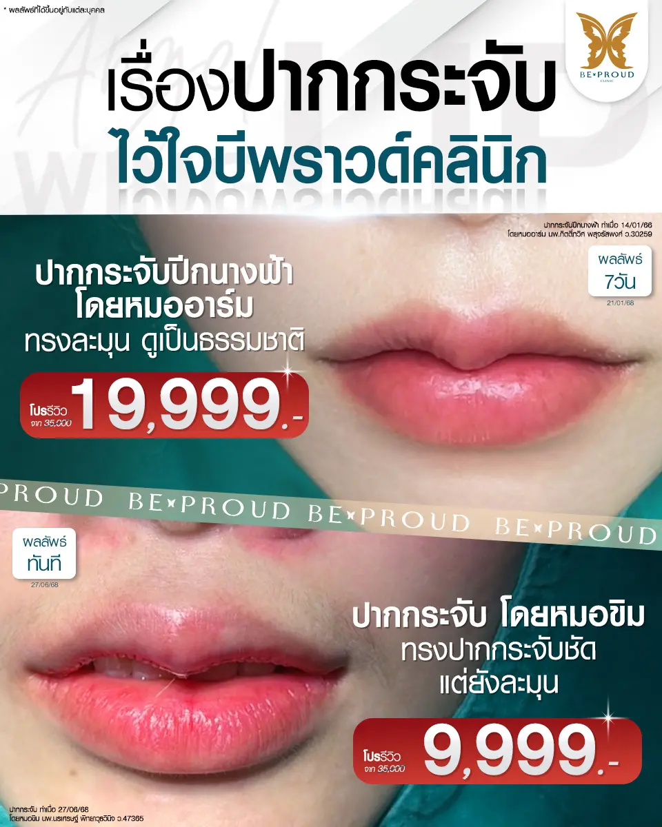 โปรโมชั่นปากกระจับปีกนางฟ้า ราคา 19,999 บาท โดยหมออาร์ม และปากกระจับ ราคา 9,999 บาท โดยหมอซิม ที่ BEPROUD Clinic