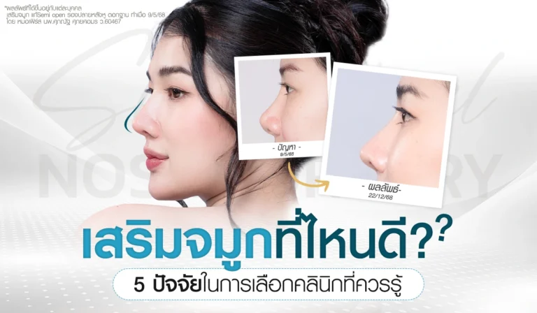 เสริมจมูกที่ไหนดี? เช็กลิสต์ 5 ปัจจัยเลือกคลินิกให้ปัง ไม่เสี่ยงพัง ด้วยเทคนิค Semi Open รองปลายหลังหูและตอกฐาน โดยหมอเฟิร์ส (นพ.ศุภณัฐ) บีพราวด์ คลินิก
