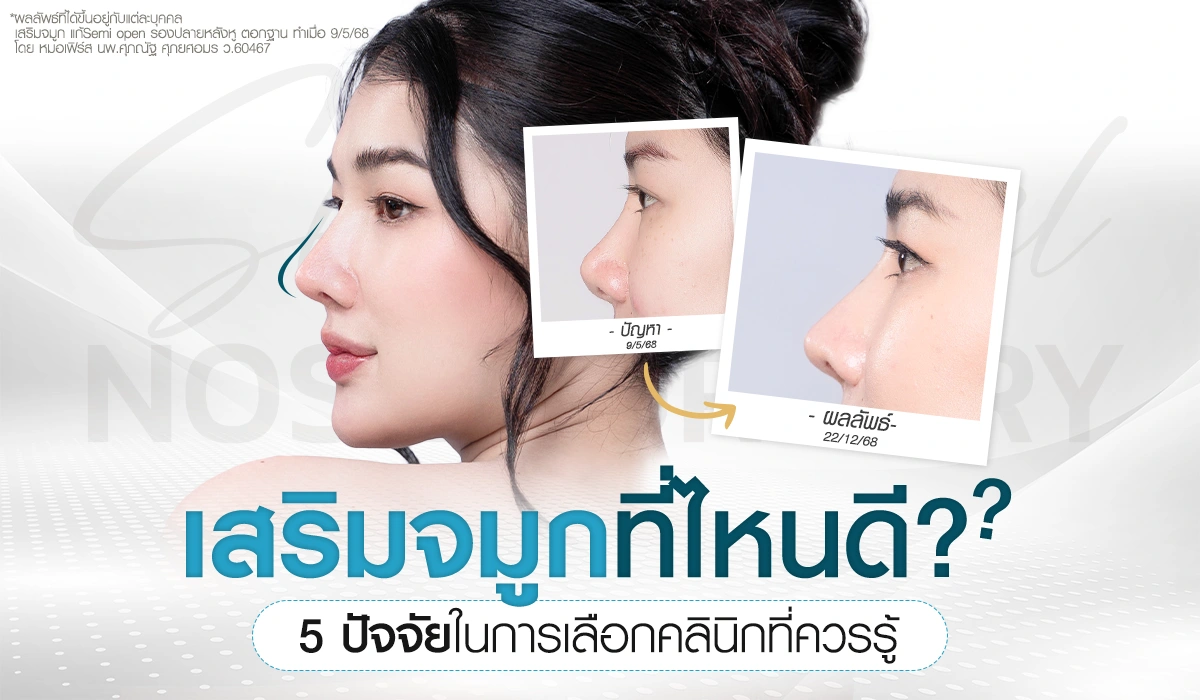 เสริมจมูกที่ไหนดี? เช็กลิสต์ 5 ปัจจัยเลือกคลินิกให้ปัง ไม่เสี่ยงพัง ด้วยเทคนิค Semi Open รองปลายหลังหูและตอกฐาน โดยหมอเฟิร์ส (นพ.ศุภณัฐ) บีพราวด์ คลินิก